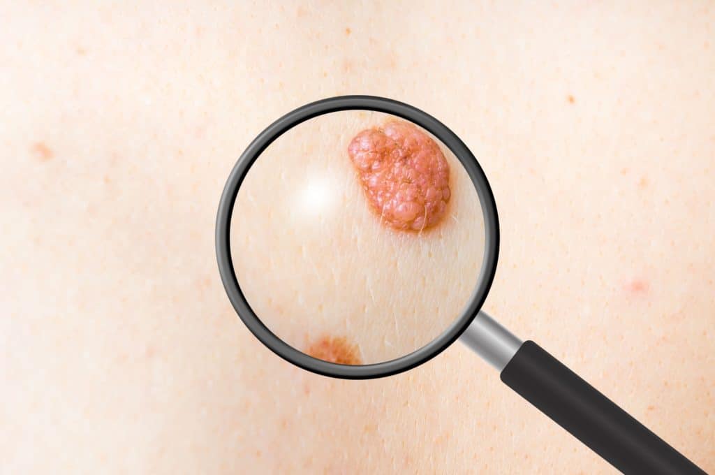 Facial Mole Removal