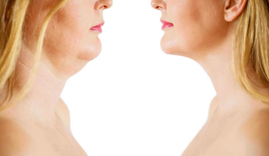 Double Chin treatment Kings Langley before and after results