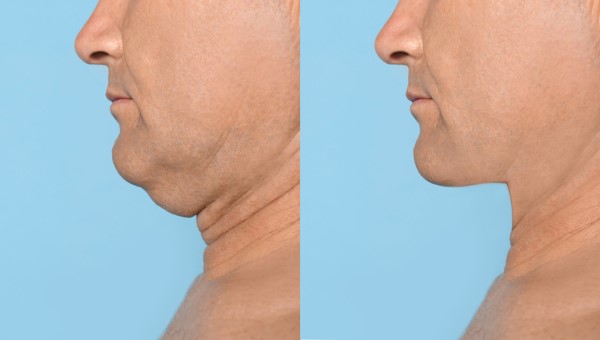 Which Non-Surgical Treatments Work Best for Jowls and Loose Skin Kings Langley?