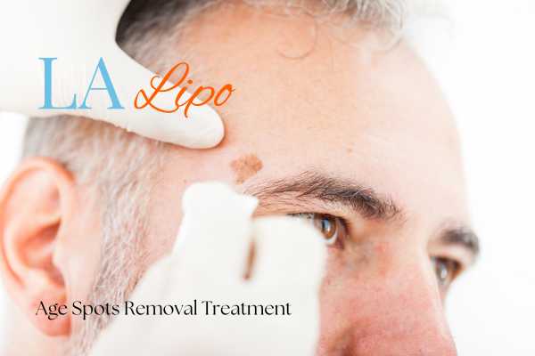 What Are the Most Effective Treatments for Age Spots Kings Langley?