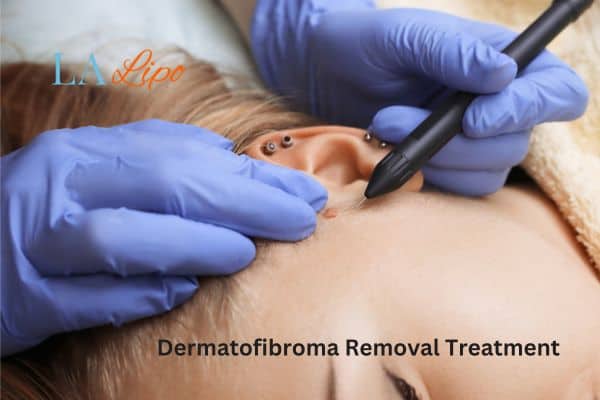 Dermatofibroma Removal Treatment Kings Langley