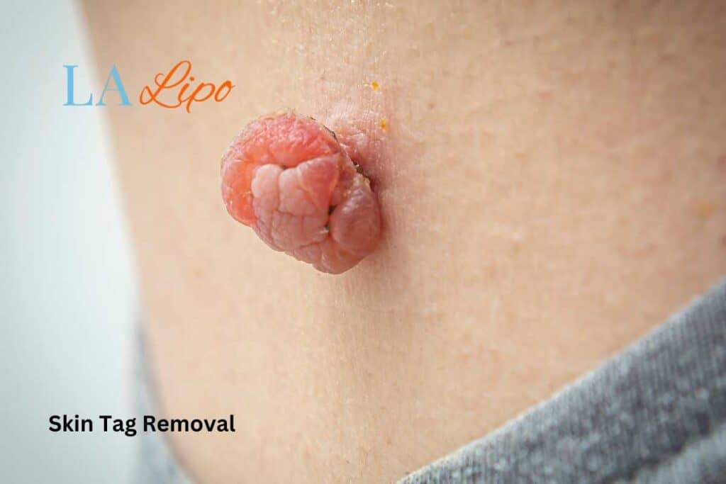 Skin Tags