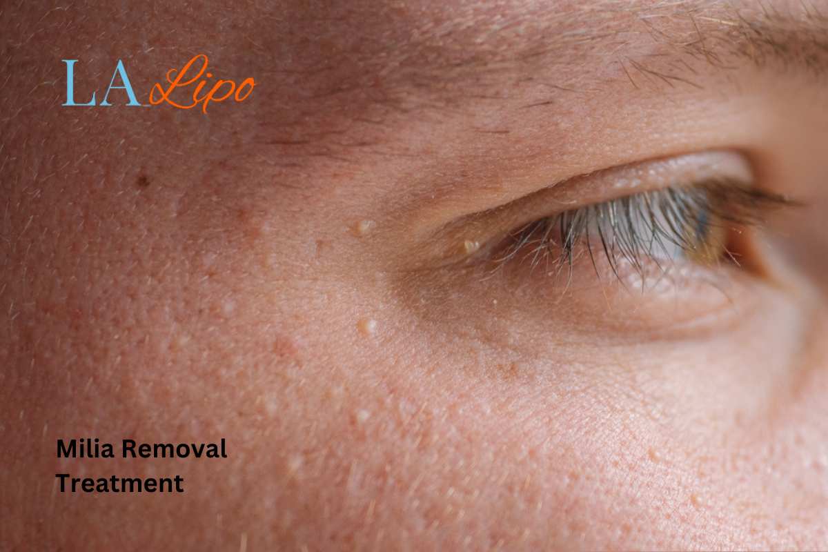 Cryopen Milia Removal: Is It the Easiest and Safest Option Kings Langley?