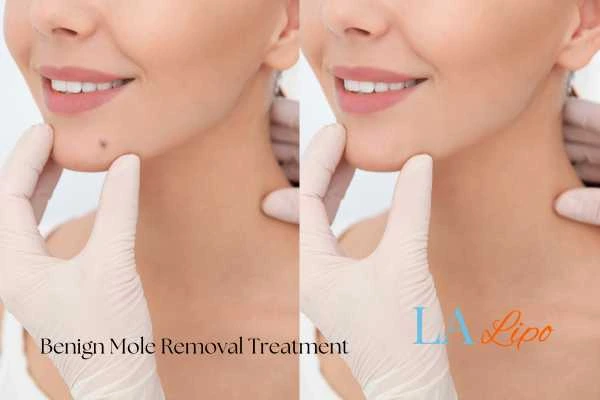 Before-and-after results following benign mole-removal treatment Kings Langley