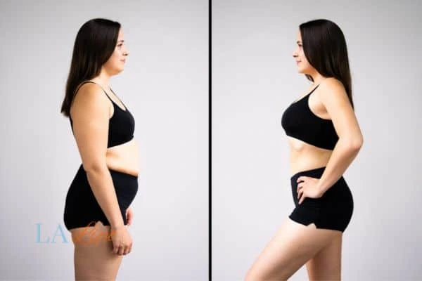 image of woman before and after results of LA-EMS Body Sculpting Kings Langley to help treat Diastasis recti