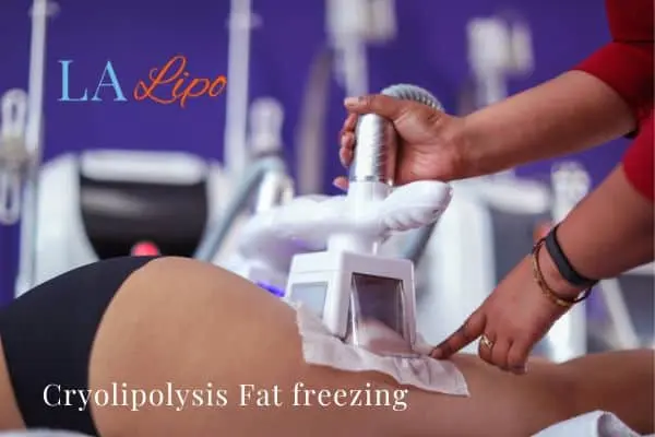 women getting fat freezing Kings Langley