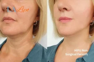 hi-fu for wrinkles Kings Langley before and after results