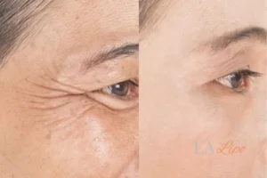 Before and after results of woman - HI-fu wrinkles reduction treatment Kings Langley