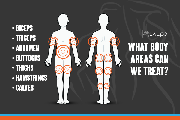 Graphic to show areas you can have LA-EMS Body Sculpting Kings Langley treatment.