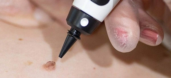 skin tag removal using cryopen Kings Langley
