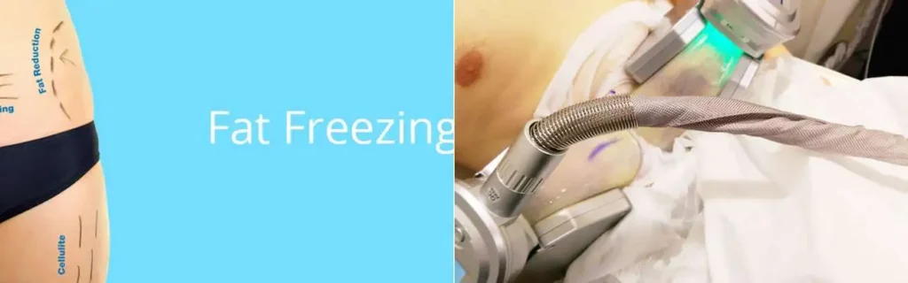 Fat freezing Kings Langley on multiple areas of the body
