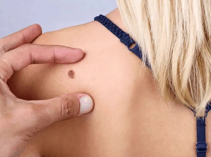 woman having mole removal Kings Langley consultation before treatment.