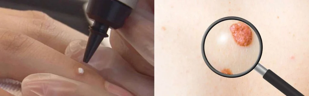 CryoPen practitioner Kings Langley assessing a benign mole before treatment