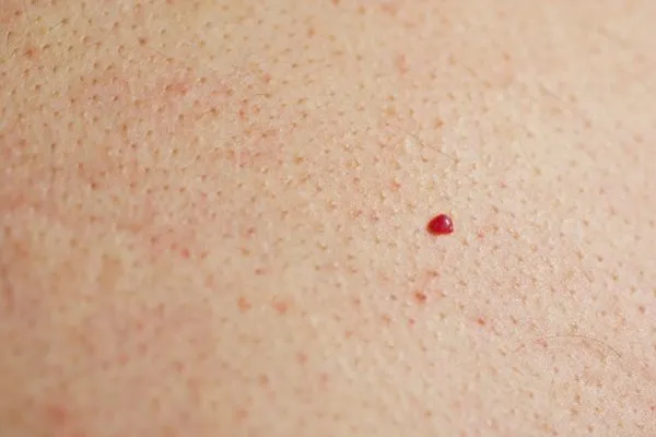 close up of a cherry angioma Kings Langley
