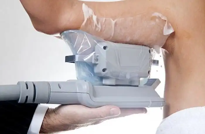 Picture of fat freezing Kings Langley on the upper arms.
