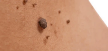 image of a skin tag Kings Langley
