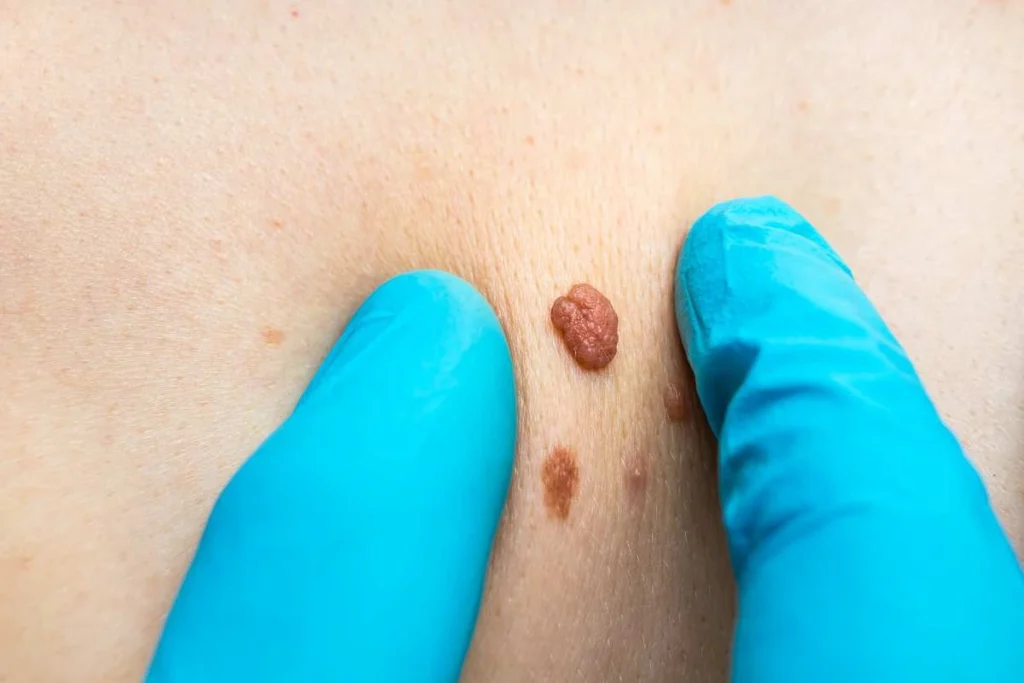 Consultant examining a skin tag Kings Langley