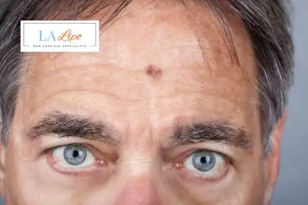 Solar Lentigo Removal Kings Langley image of man with mark on his forehead