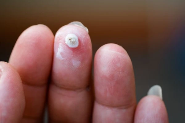 wart on person finger - cryotherapy to treat from LA LIPO Kings Langley