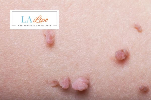 Does cryopen skin tag removal Kings Langley hurt? Find out now call our team today!