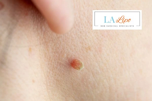 Book skin tag removal Kings Langley today speak to our team now!