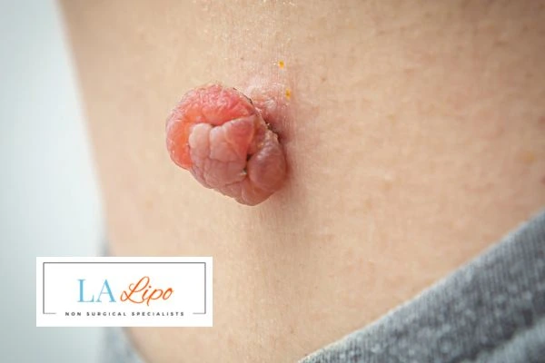 Interested in skin tag removal Kings Langley? Concerned about the pain? Find out more today!
