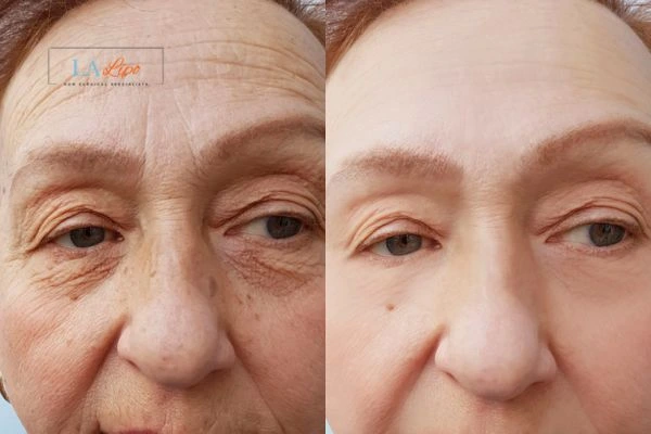 The powerful benefits of Morpheus8 Treatment Kings Langley - Call Our team today!