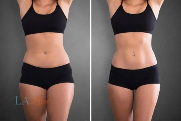 before and after results of non-surgical treatment to help a woman's body image and mental health Kings Langley