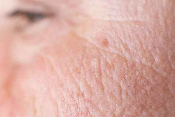 close up picture of a woman's face showing an age spot Kings Langley