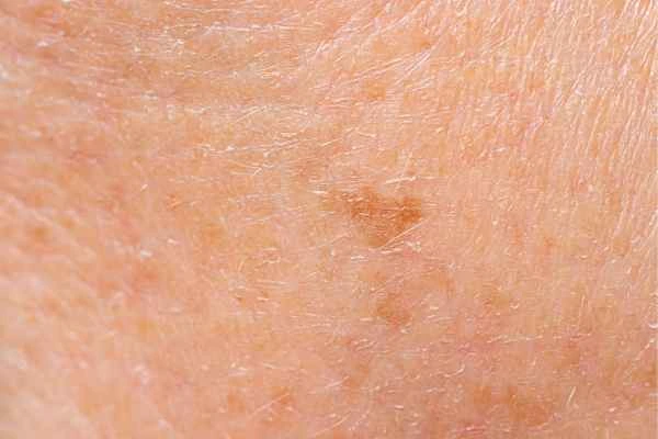 close up picture of age spots Kings Langley