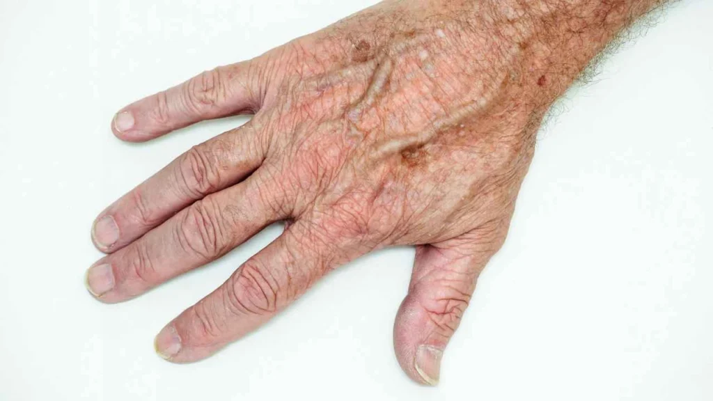 Male hand showing age spot Kings Langley
