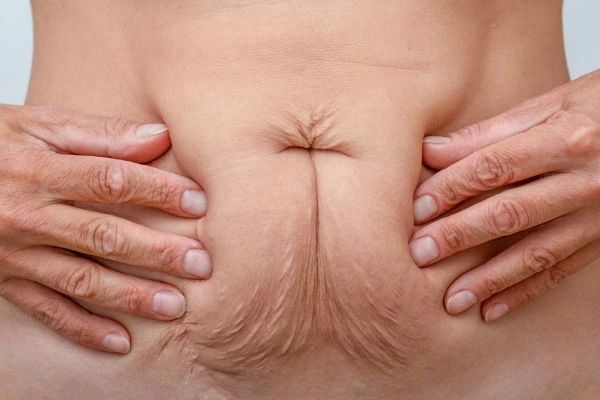 Should I Combine Diastasis Recti Treatment with Body Contouring for Better Results Kings Langley?