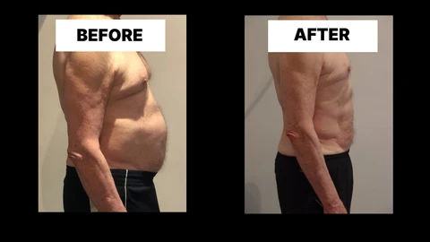 What Symptoms Can Diastasis Recti Cause in Men? Weak Core, Back Pain and Poor Posture Kings Langley
